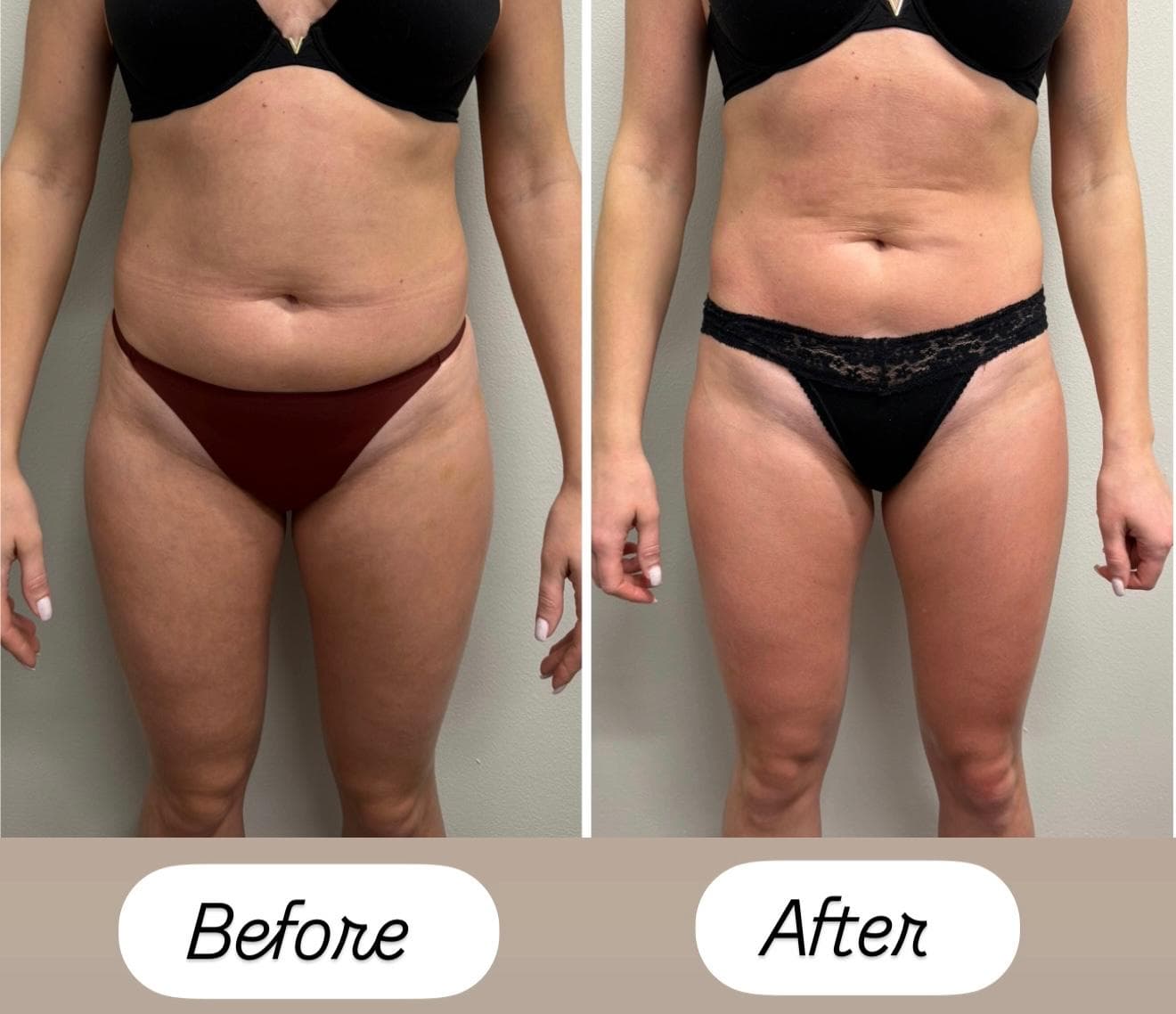 Body contouring — front view