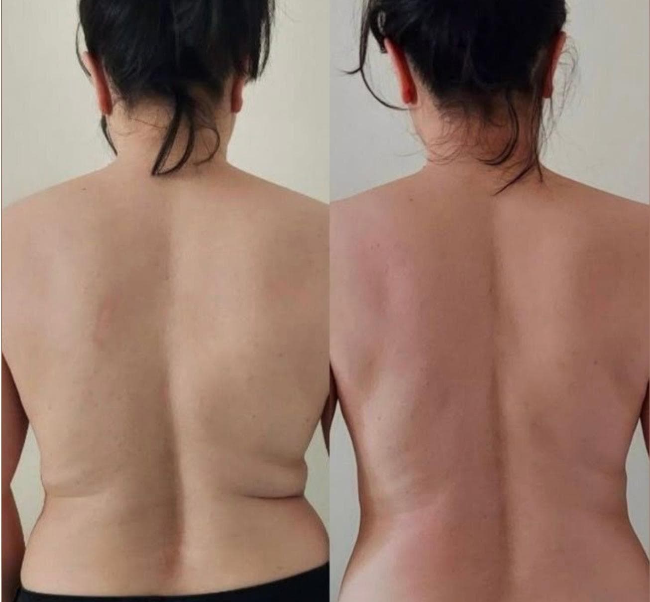 Body Contouring — Before & After