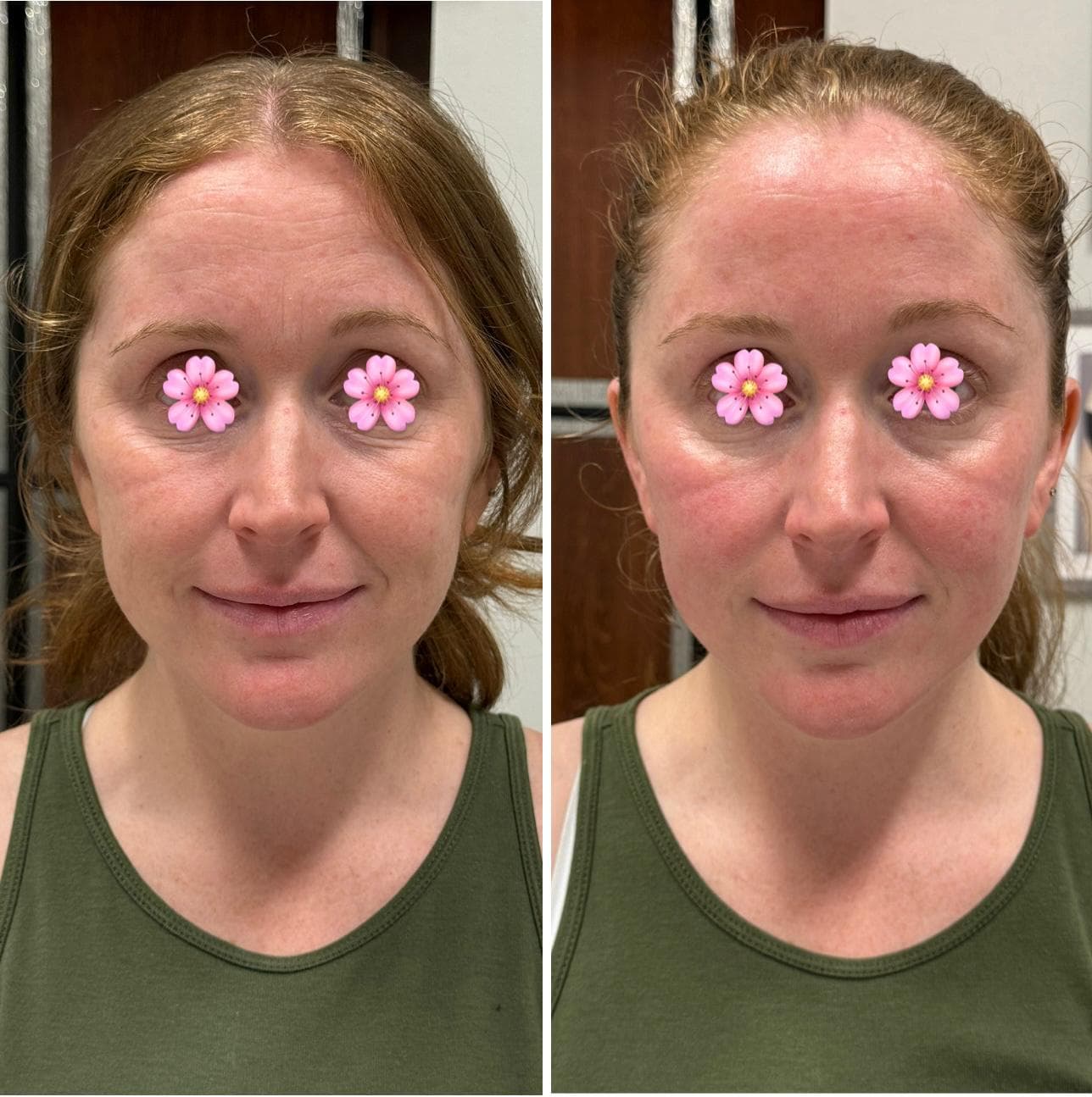 Facial Sculpting — Before & After